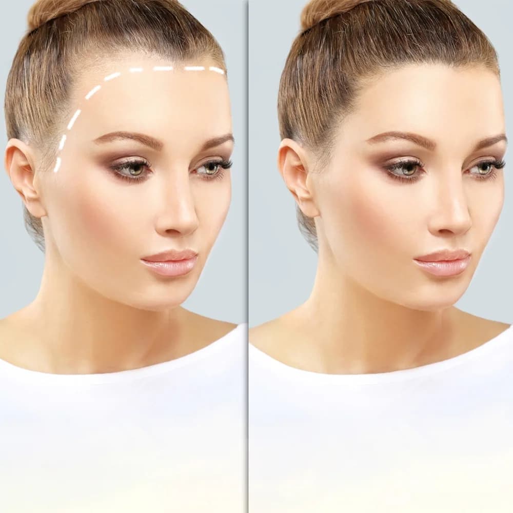 Hair Transplant London – The Most Trusted Clinic in the UK