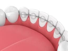 Everything You Need to Know About Ceramic Braces